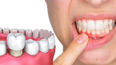 آیا روکش دندان برای کسانی که مشکلات لثه دارند مناسب است؟