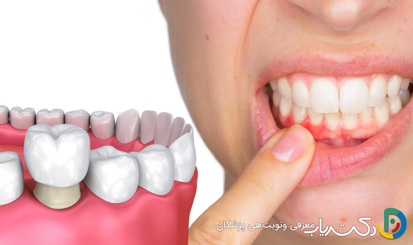 آیا روکش دندان برای کسانی که مشکلات لثه دارند مناسب است؟