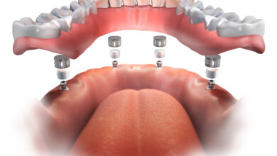 آیا دندان مصنوعی به صورت دائمی در دهان قرار می گیرد؟