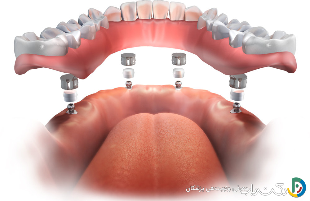 آیا دندان مصنوعی به صورت دائمی در دهان قرار می گیرد؟