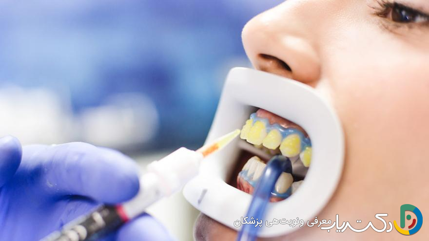 آیا باید پس از بلیچینگ از محصولات خاص برای سفید نگه داشتن دندانها استفاده کنیم؟