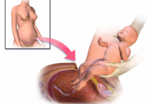 هزینه عمل سزارین در تهران (تعرفه های دولتی و خصوصی)
