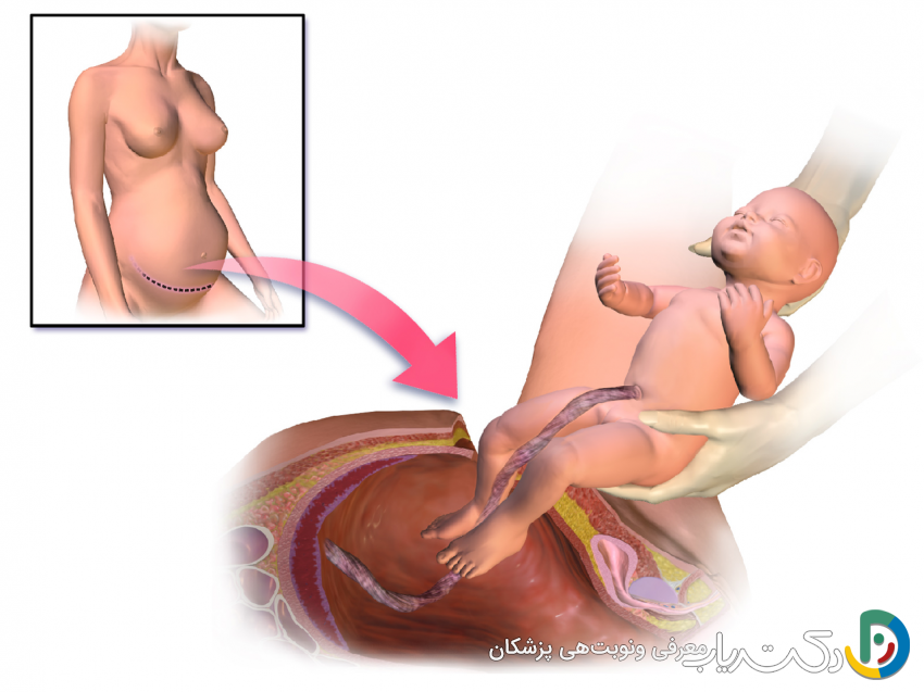هزینه عمل سزارین در تهران (تعرفه های دولتی و خصوصی)