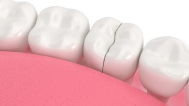 آیا ممکن است روکش دندان شکسته یا ترک بخورد؟