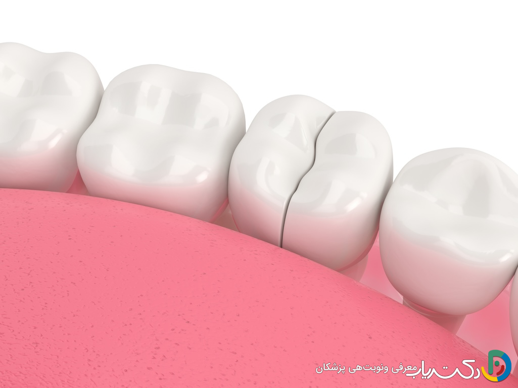 آیا ممکن است روکش دندان شکسته یا ترک بخورد؟