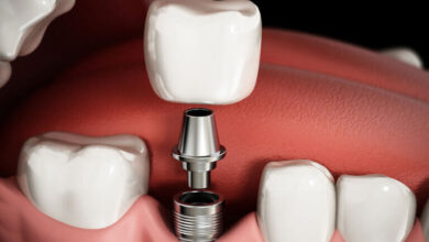 آیا ایمپلنت لق شده قابل درمان است؟