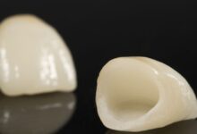 آیا روکش دندان ممکن است کنده شود؟