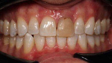 آیا روکش دندان می تواند باعث تغییر رنگ دندان شود؟