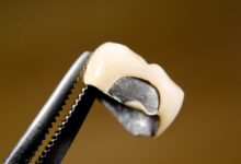 آیا روکش دندان می تواند به دندان آسیب بزند؟