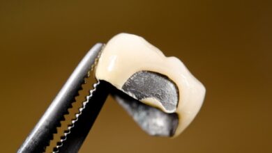 آیا روکش دندان می تواند به دندان آسیب بزند؟