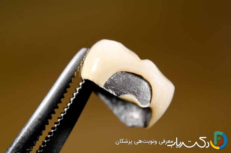 آیا روکش دندان می تواند به دندان آسیب بزند؟