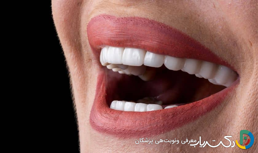 آیا روکش دندان می تواند به زیبایی لبخند کمک کند؟