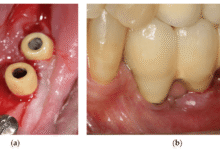 آیا ممکن است ایمپلنت دندان باعث آلرژی یا حساسیت شود؟