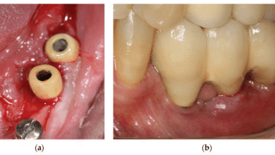 آیا ممکن است ایمپلنت دندان باعث آلرژی یا حساسیت شود؟