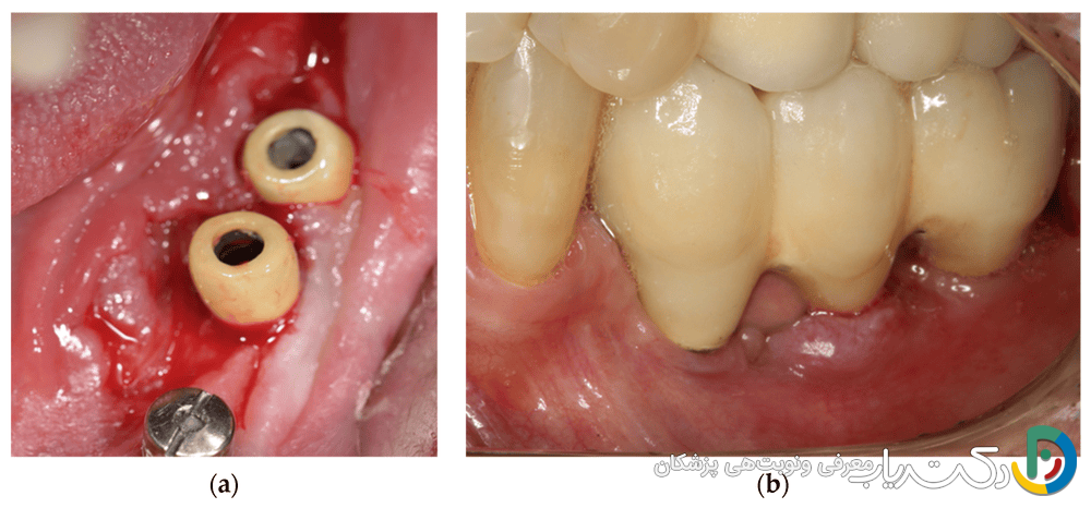 آیا ممکن است ایمپلنت دندان باعث آلرژی یا حساسیت شود؟