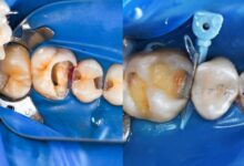 آیا ترمیم دندان می تواند باعث حساسیت دندان ها شود؟