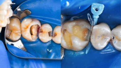 آیا ترمیم دندان می تواند باعث حساسیت دندان ها شود؟