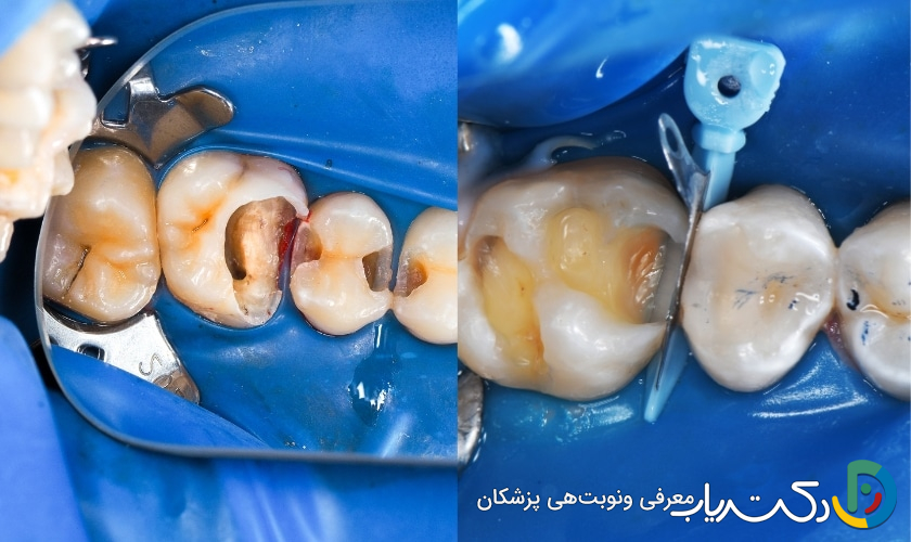 آیا ترمیم دندان می تواند باعث حساسیت دندان ها شود؟