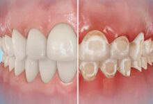 آیا ارتودنسی می تواند باعث آسیب به دندان ها شود؟