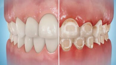 آیا ارتودنسی می تواند باعث آسیب به دندان ها شود؟