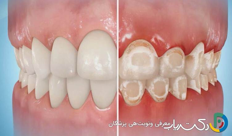 آیا ارتودنسی می تواند باعث آسیب به دندان ها شود؟
