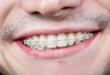 آیا ممکن است ارتودنسی باعث بروز حساسیت دندانی شود؟