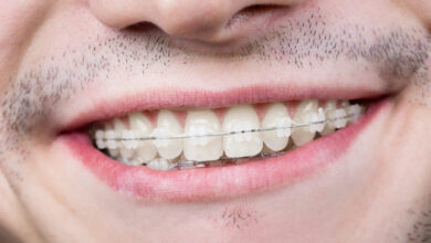 آیا ممکن است ارتودنسی باعث بروز حساسیت دندانی شود؟