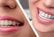 آیا ارتودنسی می تواند مشکلات دندانی را برای همیشه حل کند؟