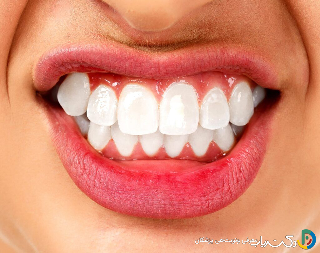 آیا افرادی که دندان قروچه دارند، می توانند ایمپلنت کنند؟