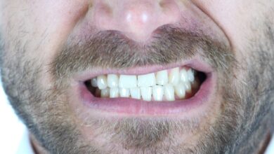آیا افراد با دندان قروچه می توانند کامپوزیت کنند؟