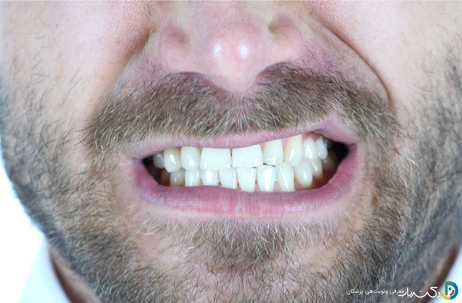 آیا افراد با دندان قروچه می توانند کامپوزیت کنند؟