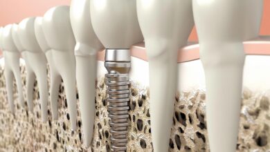 آیا افراد مبتلا به پوکی استخوان می توانند ایمپلنت بگذارند؟