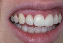 آیا بلیچینگ دندان می تواند باعث آسیب به لثه ها شود؟