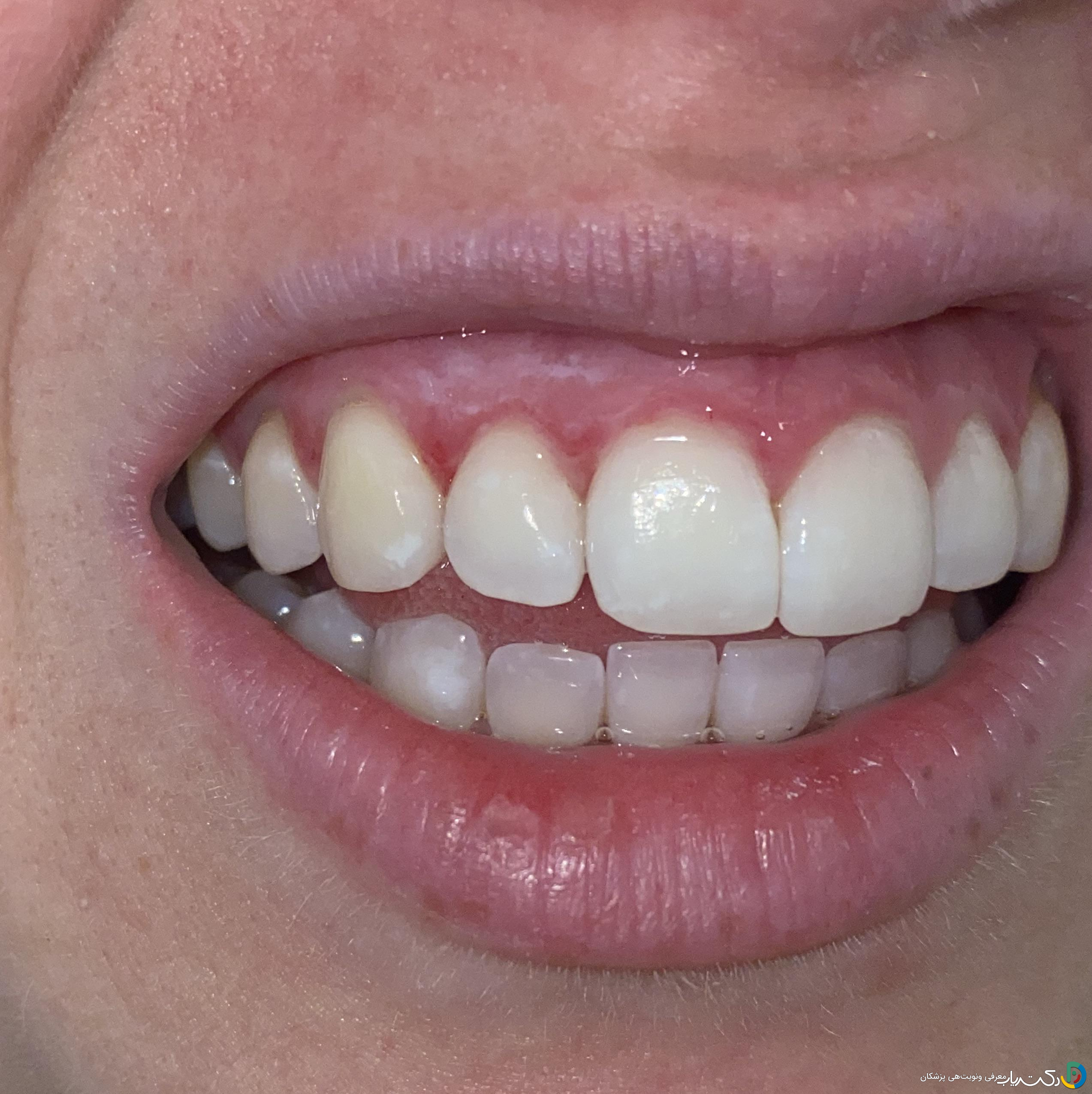 آیا بلیچینگ دندان می تواند باعث آسیب به لثه ها شود؟