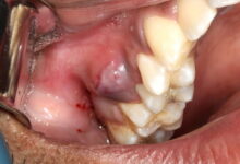 آیا عصب کشی ممکن است باعث عفونت شود؟