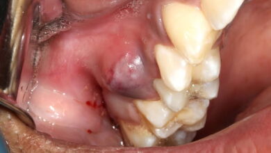 آیا عصب کشی ممکن است باعث عفونت شود؟