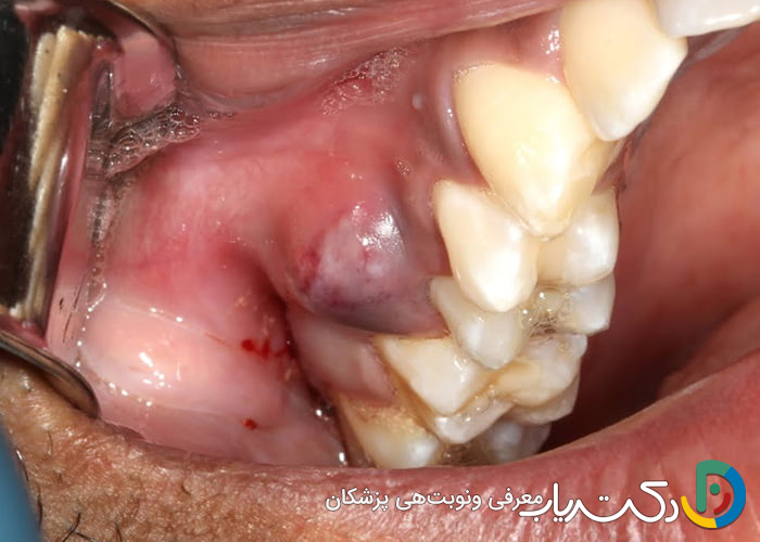 آیا عصب کشی ممکن است باعث عفونت شود؟