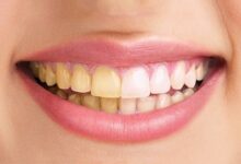 مهم ترین علت تغییر رنگ لمینت دندان : حفظ درخشش لبخند شما
