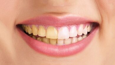 مهم ترین علت تغییر رنگ لمینت دندان : حفظ درخشش لبخند شما