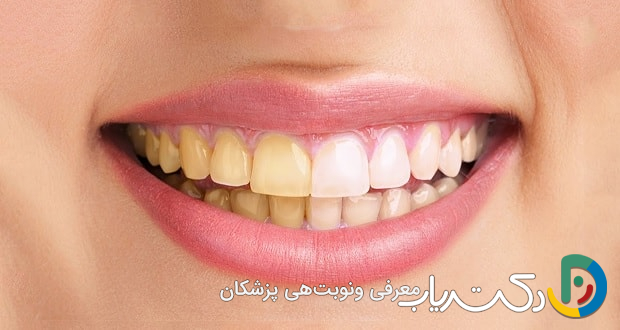 مهم ترین علت تغییر رنگ لمینت دندان : حفظ درخشش لبخند شما