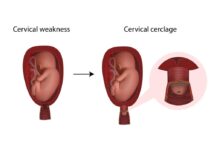 قیمت جراحی سرکلاژ در تهران (تعرفه های دولتی و خصوصی)