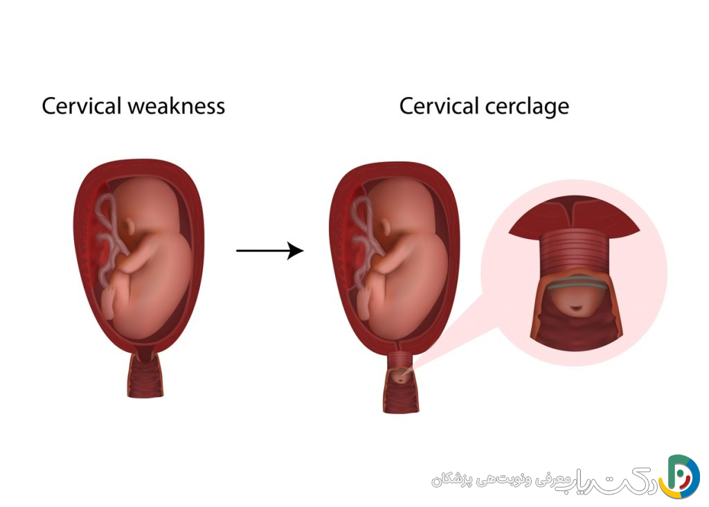 قیمت جراحی سرکلاژ در تهران (تعرفه های دولتی و خصوصی)