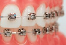 ارتودنسی دیمون چیست ؟ مزایا و معایت آن