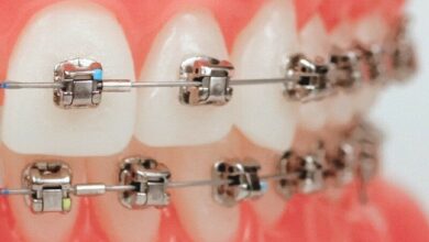 ارتودنسی دیمون چیست ؟ مزایا و معایت آن