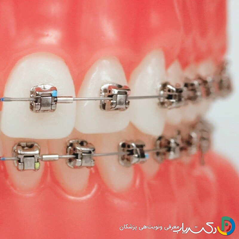 ارتودنسی دیمون چیست ؟ مزایا و معایت آن