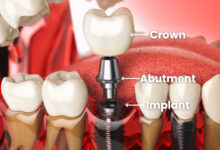 اباتمنت Abutment چیست و چه زمانی نصب می شود؟