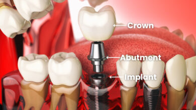 اباتمنت Abutment چیست و چه زمانی نصب می شود؟