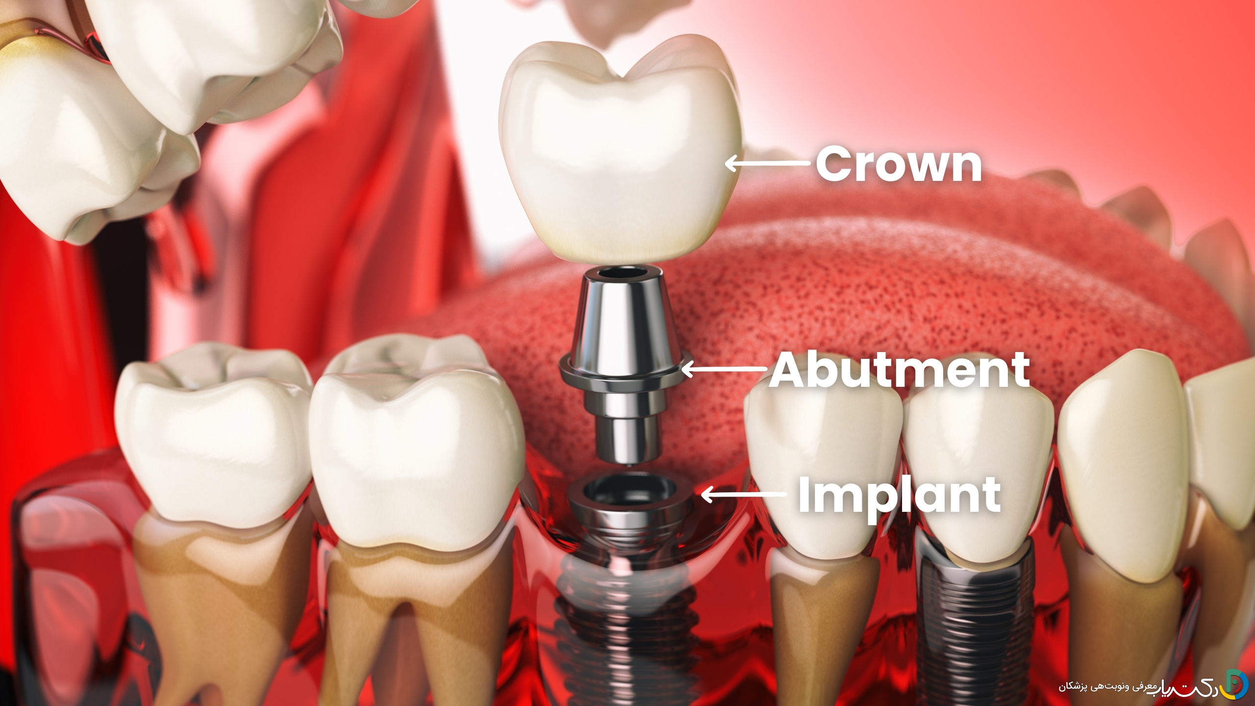 اباتمنت Abutment چیست و چه زمانی نصب می شود؟
