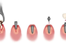 چه خطرات یا مشکلاتی ممکن است در طول فرآیند ایمپلنت دندان پیش آید؟