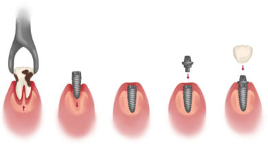 چه خطرات یا مشکلاتی ممکن است در طول فرآیند ایمپلنت دندان پیش آید؟